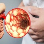 Bệnh viêm ruột mạn tính – Chẩn đoán và điều trị (Phần 1)