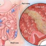 Bệnh Crohn và bệnh túi mật