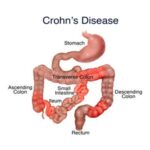 Tại sao bệnh Crohn lại phổ biến ở người Do Thái?