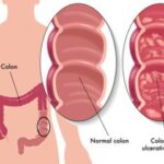 Lịch sử và cơ chế bệnh sinh của bệnh Crohn