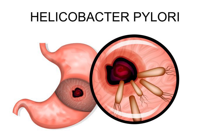 Liệu pháp quang động học và vắc-xin trong điều trị helicobacter pylori