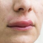 Hội chứng dị ứng miệng (oral allergy syndrome – OAS) là gì?