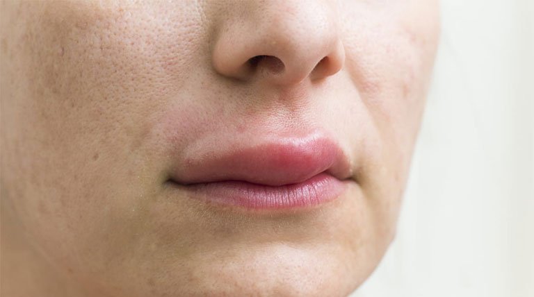 Hội chứng dị ứng miệng (oral allergy syndrome – OAS) là gì?