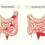 Khi nào nên chọn thuốc ức chế sinh học để điều trị bệnh Crohn?