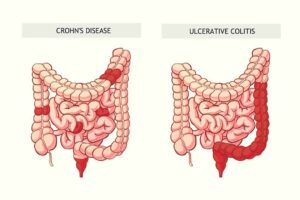 Khi nào nên chọn thuốc ức chế sinh học để điều trị bệnh Crohn?