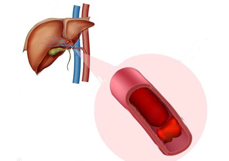 Huyết khối tĩnh mạch cửa là gì?