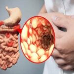 Bệnh Crohns: Hướng dẫn xử trí trong đợt bùng phát khẩn cấp