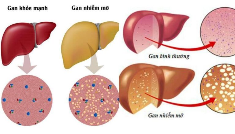 Béo phì và bệnh gan nhiễm mỡ liên quan đến rối loạn chức năng chuyển hóa trước và sau ghép gan