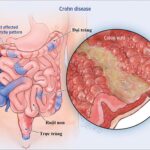 Mối liên hệ giữa bệnh Crohn và sữa