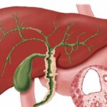Vai trò của axit mật trong bệnh gan ứ mật do hệ vi sinh vật đường ruột làm trung gian