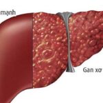 Vai trò của axit mật trong bệnh xơ gan do hệ vi sinh vật đường ruột làm trung gian