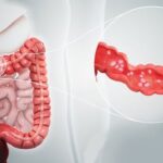 Tại sao bệnh lý răng miệng lại tăng nguy cơ viêm loét đại tràng