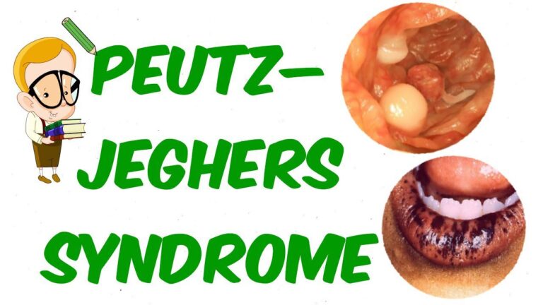 Hội chứng Peutz-Jeghers là gì và có liên quan thế nào tới ung thư đường tiêu hóa?