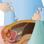 Phẫu thuật nội soi ổ bụng thường chỉ định trong trường hợp nào?