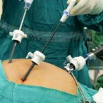 Phẫu thuật nội soi cắt ruột thừa (1 lỗ) thực hiện thế nào?