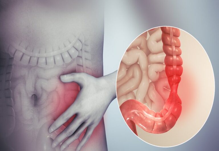 Mối liên hệ giữa bệnh Crohn và đau khớp