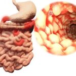 Phân loại 5 kiểu bệnh Crohn