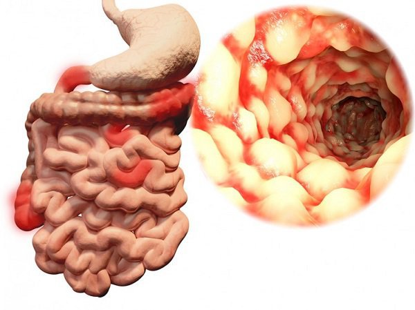 Phân loại 5 kiểu bệnh Crohn