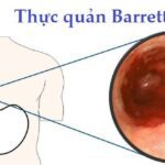 Barrett thực quản – “người quen” của trào ngược dạ dày thực quản