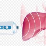 Kết quả đo mức gan nhiễm mỡ sau siêu âm đánh giá xơ hóa gan (Fibrosis)