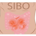 Sự phát triển quá mức của vi khuẩn ở ruột non (SIBO)