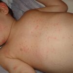 Mũi tiêm nào cần thiết để phòng tránh sốt nhiễm siêu vi ở trẻ?