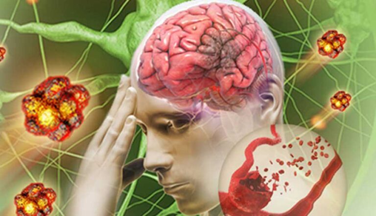 Tắc mạch máu não kèm đau nhức đầu điều trị thế nào?