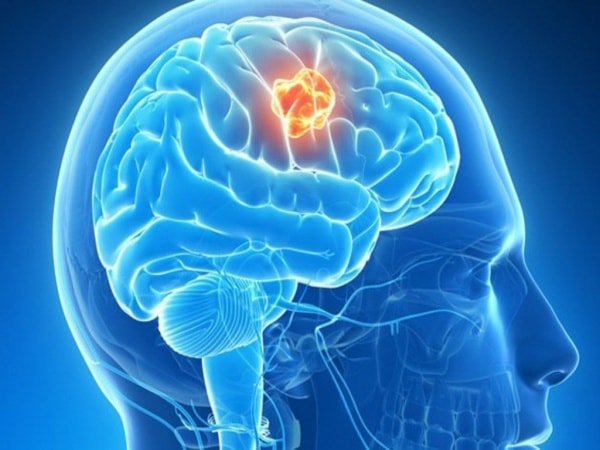 Người bệnh sau xạ trị u não hố sau có thể sống được bao lâu?