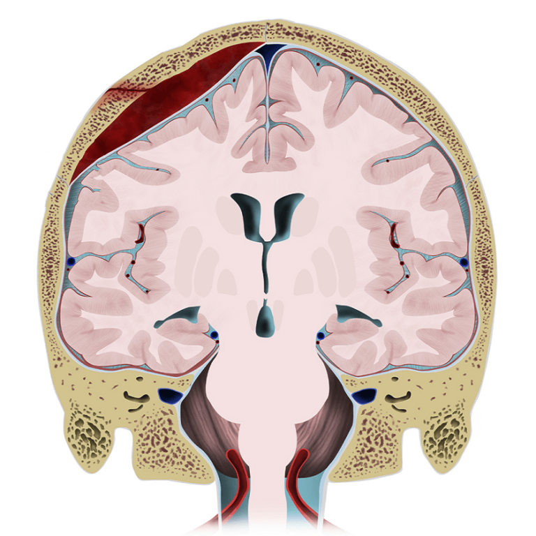 Ù tai sau phẫu thuật tụ máu não ngoài màng cứng phải làm sao?