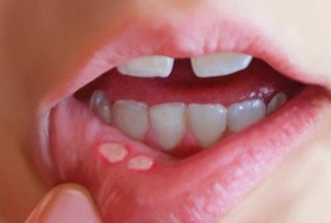 Bị nhiệt miệng và lưỡi kéo dài có phải ung thư khoang miệng?