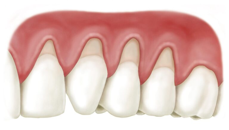 Cao răng có dấu hiệu tụt lợi và hư chân răng nên khám và điều trị thế nào?