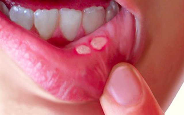 Nhiệt miệng không có mủ kèm đau nhưng điều trị không khỏi là dấu hiệu của bệnh gì?
