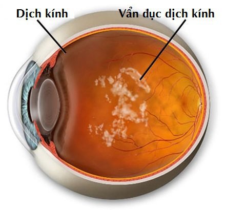Vệt đen lơ lửng trong mắt sau phẫu thuật đục thuỷ tinh thể có phải do đục dịch kính không?