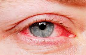 Mắt nổi tia máu và đốm nâu ở lòng trắng mắt phải điều trị thế nào?