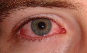 Nguyên nhân mắt đỏ, đau tức nhẹ kèm ghèn?