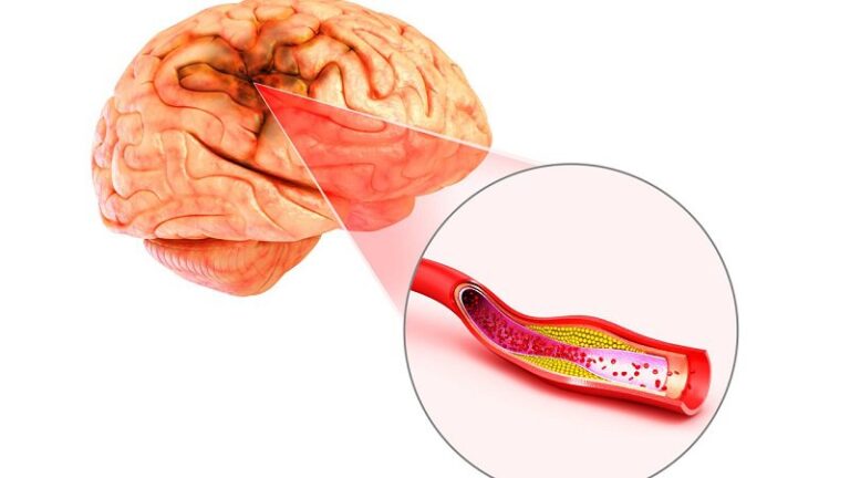 Xuất huyết não thùy thái dương do tai biến có nguy hiểm không?