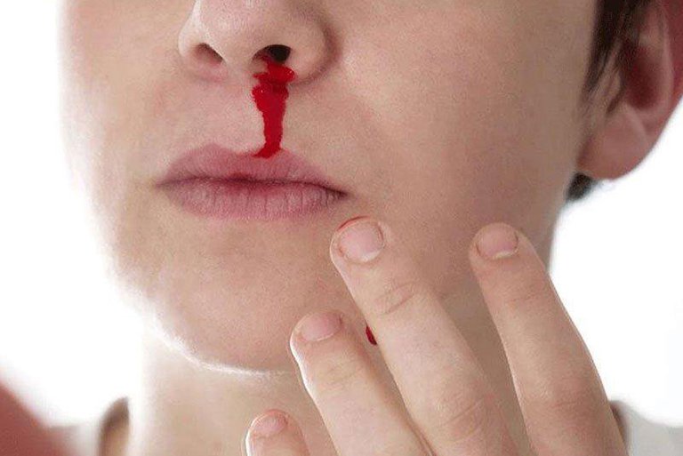 Đột nhiên chóng mặt, mắt tối sầm kèm chảy máu mũi là dấu hiệu bệnh gì?