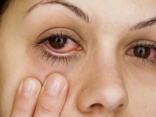 Phần lòng trắng mắt có nhiều tia máu đỏ là dấu hiệu bệnh gì?