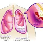 Viêm màng phổi có dịch có nguy hiểm không?