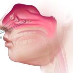 Nữ giới nghẹt mũi sau khi mổ polyp mũi điều trị như thế nào?