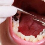 Răng sâu đen có nên bọc răng sứ không?