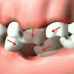 Người mất răng số 6 chưa đủ tuổi trồng implant nên làm gì?